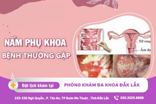 Nấm phụ khoa xảy ra phổ biến ở chị em phụ nữ hiện nay